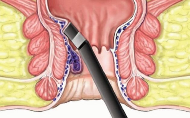 hemorrhoid coagulation in hemorrhoids